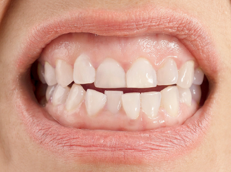 nava dental blog6 img2