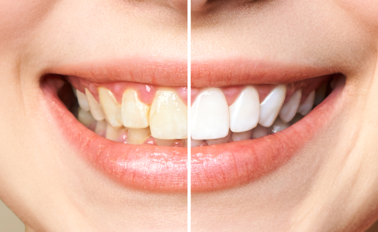 Cosmetic Teeth Whitening